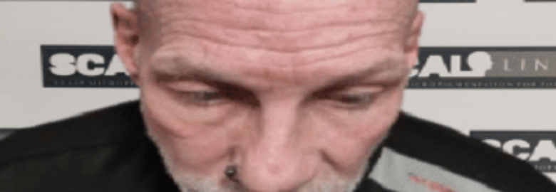 Scalpliners Scalp Micropigmentaion Kent